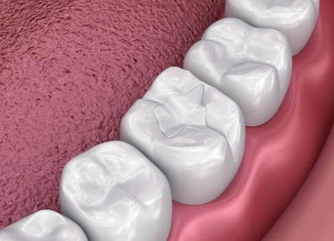 Restorative Dentistry at Livingston Dental Group