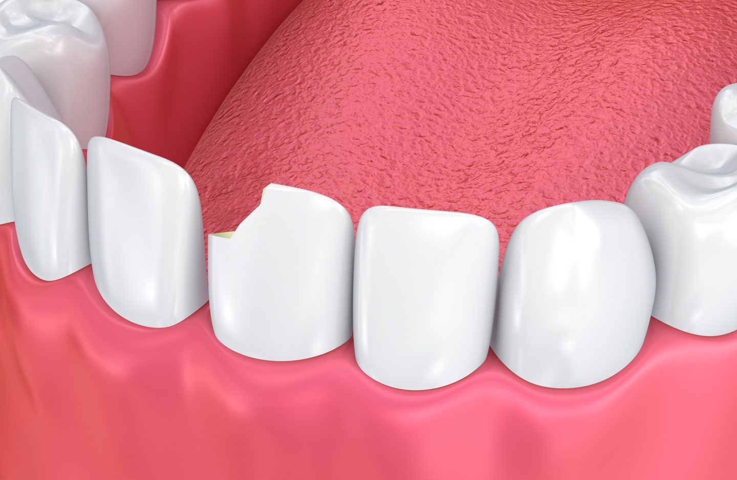 Dental Bonding at Livingston Dental Group