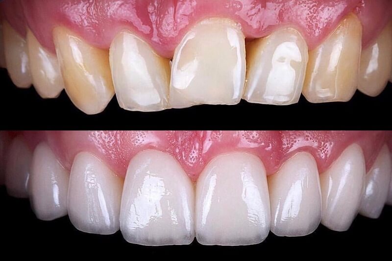Dentalveneers