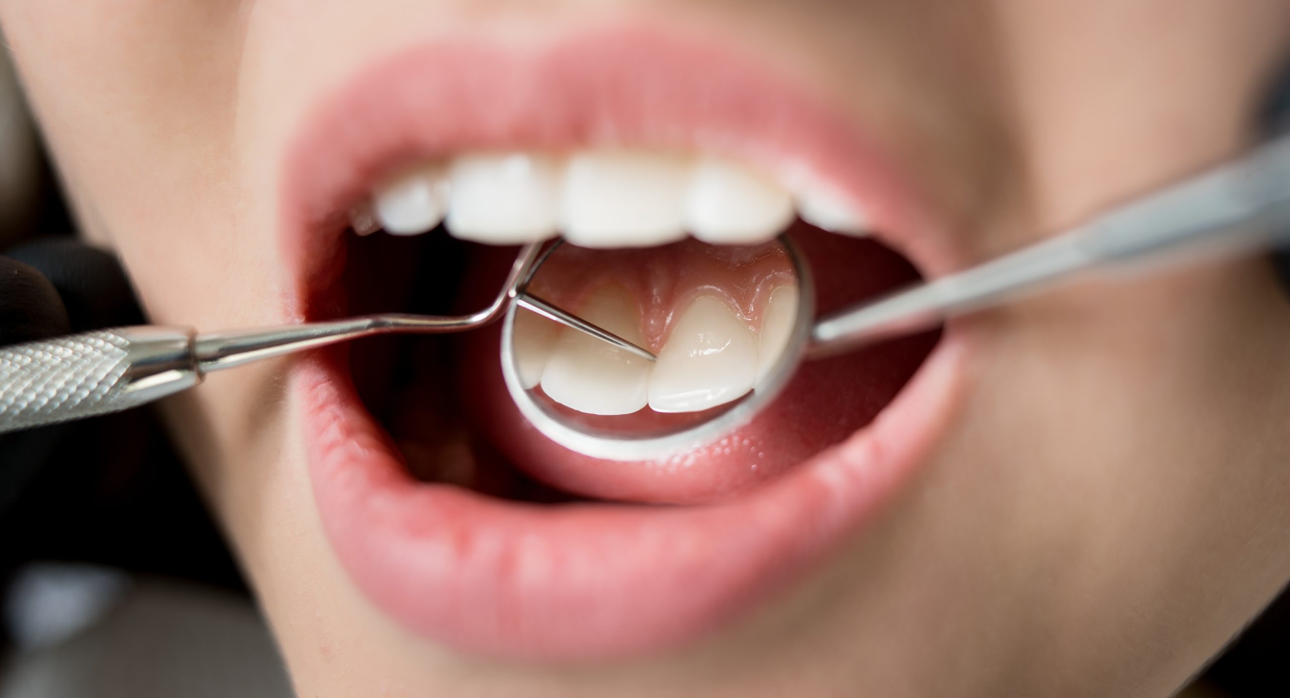 Macro Shot Of Woman Having Dental Check Up In Dental Clinic. Dentist Examining A Patient's Teeth