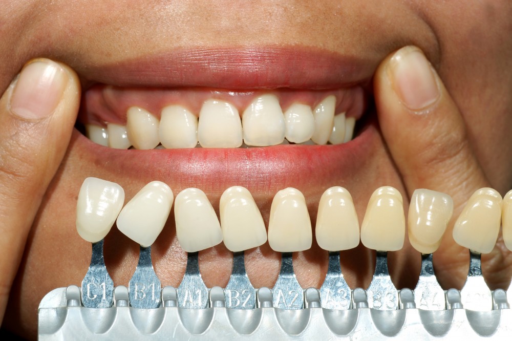 Dental Bonding