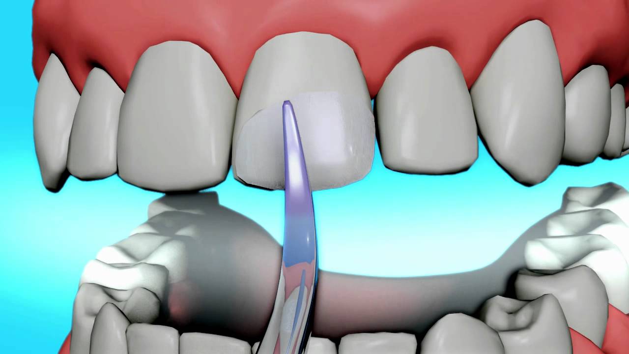 Dental Bonding2