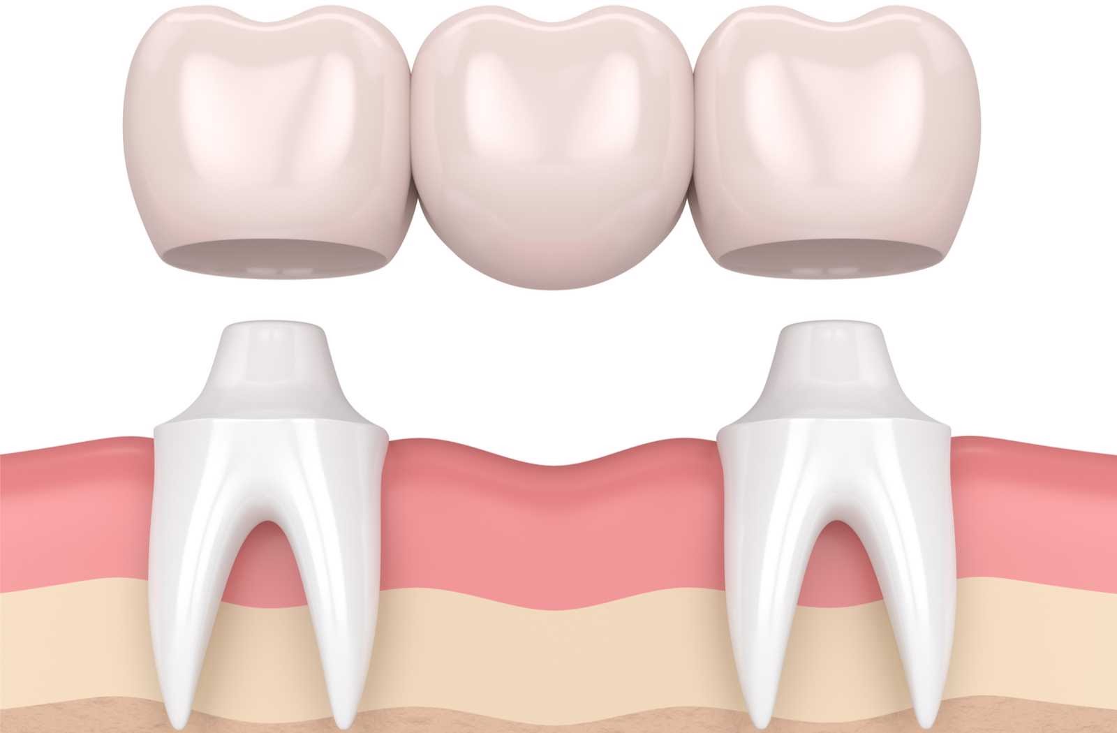 Dental Bridge Vector