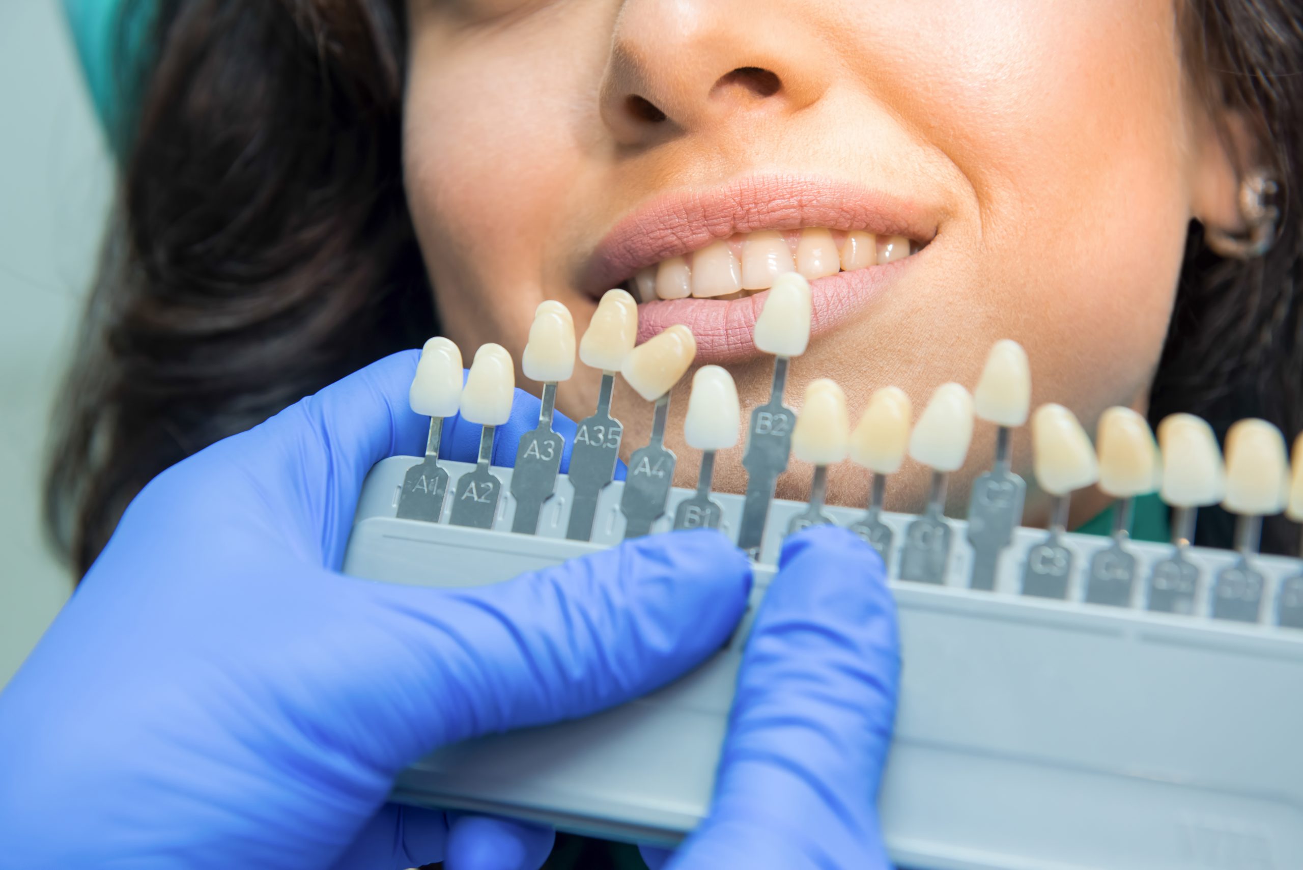 Tooth Whitening Chart.