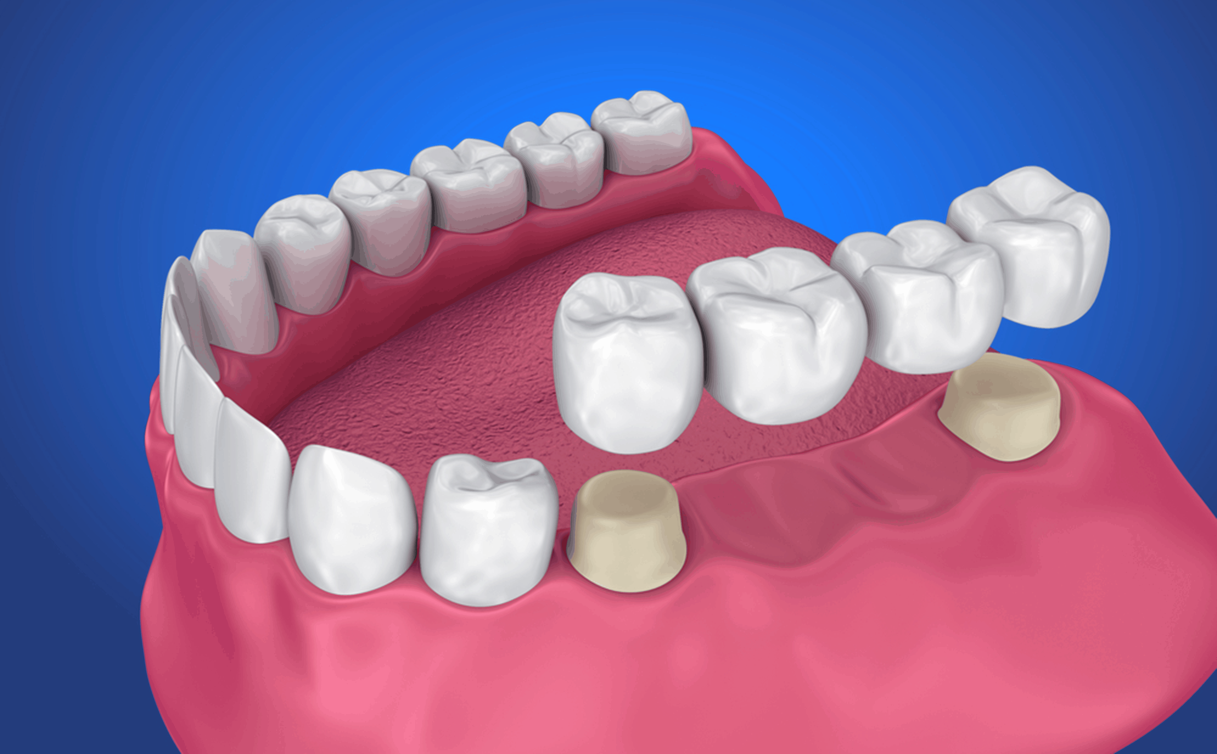 Life Of Your Dental Bridge