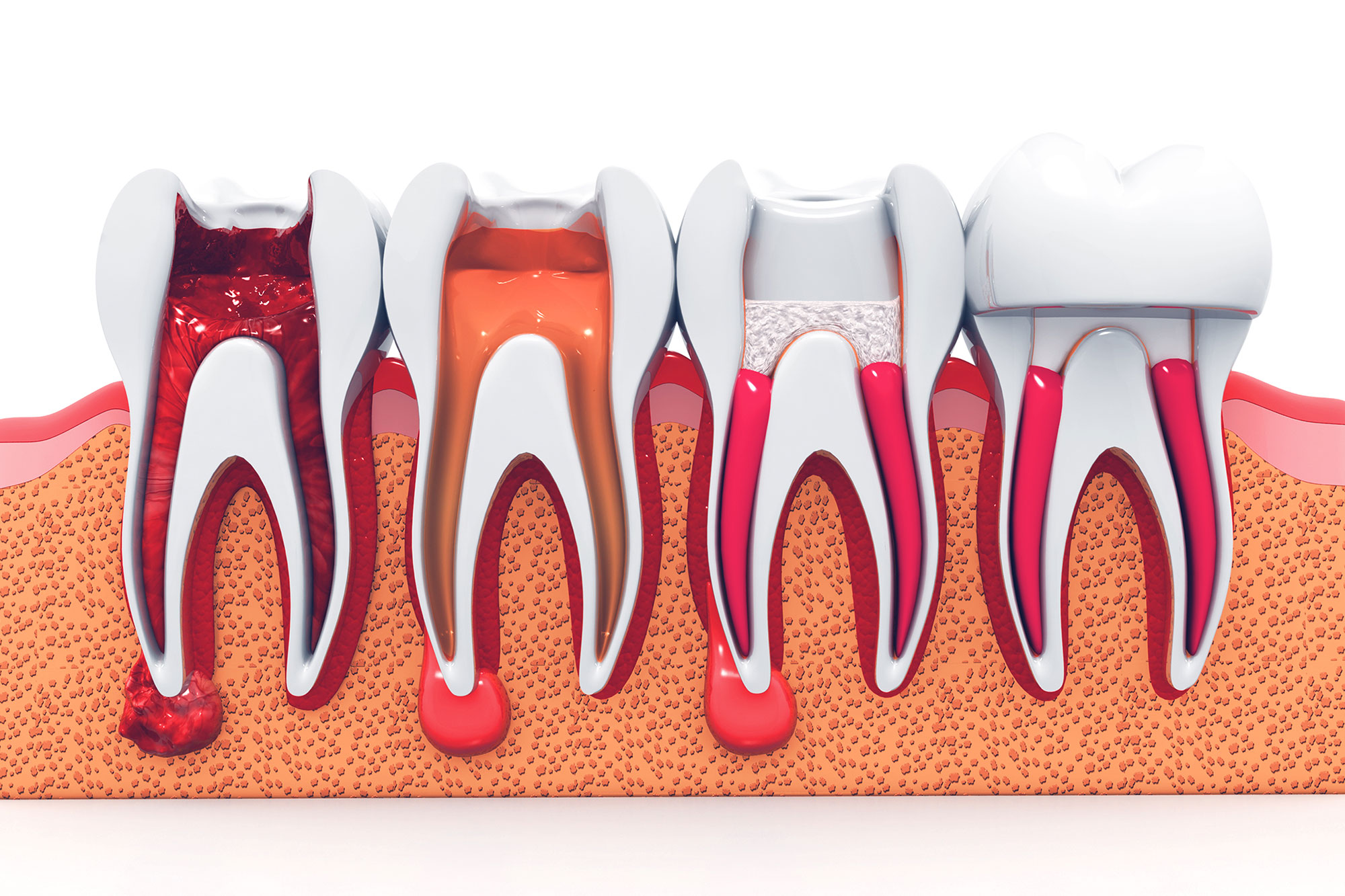 Root Canal Therapy