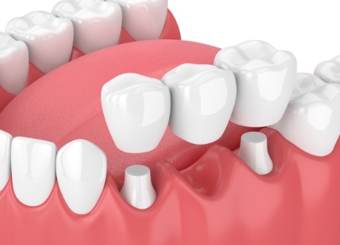 Restorative Dentistry at Livingston Dental Group